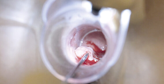 Qua trình điều trị trĩ bằng sóng cao tần RFA